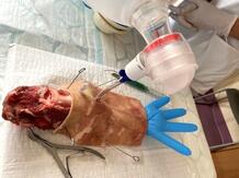 Koniotomie und Beatmung über endotrachealen Tubus. Der sich mit Luft füllende Handschuh dient der Lagekontrolle.